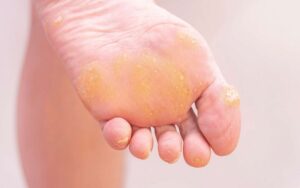 Treating Corns And Calluses