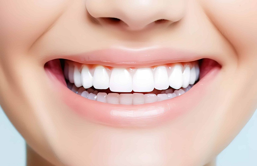 Smile With Dental Veneers