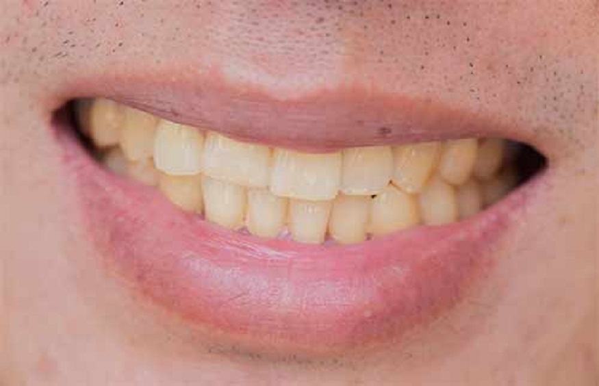 Tooth Discoloration